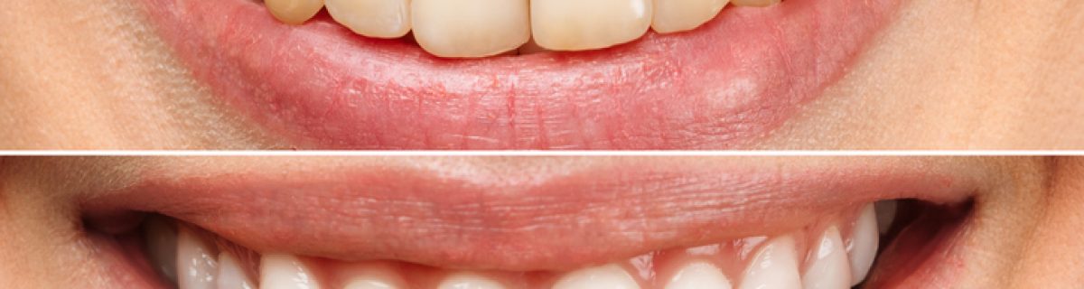 הלבנת שיניים